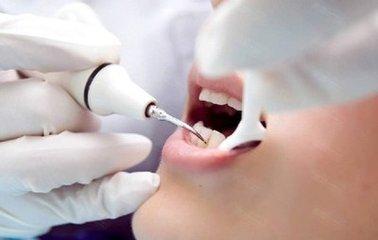 杭州美奧口腔怎么樣？洗牙能去除煙漬嗎