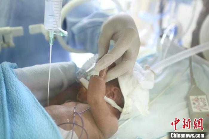 報告稱：中國極早產(chǎn)兒、極低出生體重早產(chǎn)兒存活率明顯提高