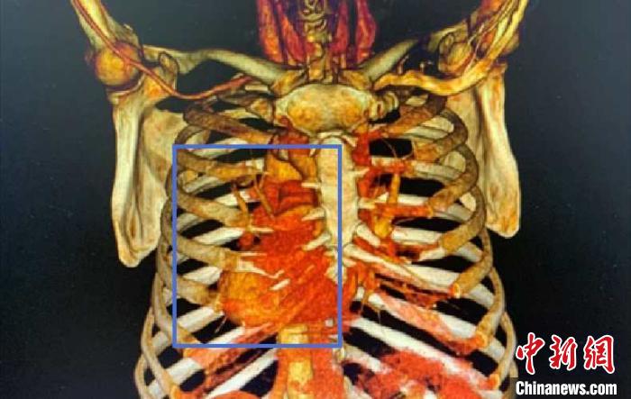 上海專家獨(dú)辟新徑成功救治天生“異”心人