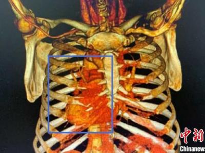 上海市權(quán)威專家獨(dú)辟新徑取得成功救護(hù)與生俱來(lái)“異”心人