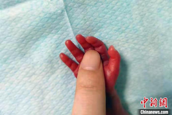 皮膚薄如紙?bào)w重780g 湖北一超早產(chǎn)兒經(jīng)救治順利脫險(xiǎn)