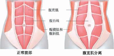 產后有了肚腩，該咋辦？（醫說新語）
