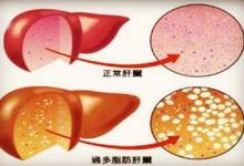 從脂肪肝到肝癌只需4步！做錯這6件事，最容易得脂肪肝！