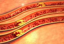 血管洗個澡，健康活到老！