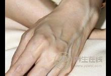 請問身上青筋多說明體內寒濕重嗎