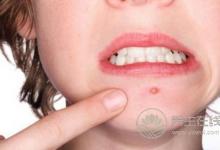 如何應對痘痘來襲？