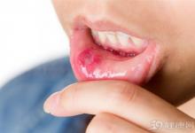5個偏方 助你輕松“搞定”口腔潰瘍！