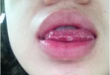 口腔潰瘍痛到發(fā)瘋，3個(gè)小妙招可快速治愈