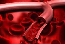 小心！血管都是被這幾個壞習慣毀掉的