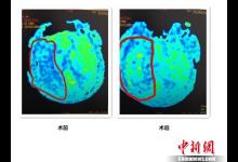 吃外賣、熬夜、少運(yùn)動(dòng) 小白領(lǐng)突發(fā)腦梗