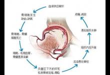 股骨頭壞死怎么緩解疼痛