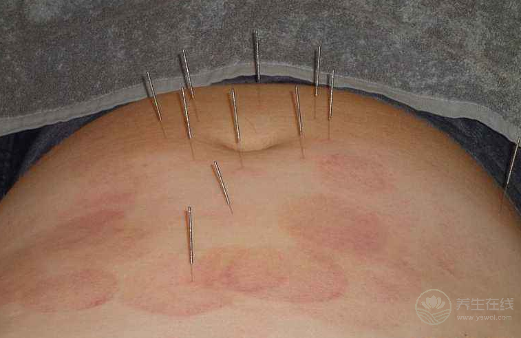 針灸養(yǎng)生 針灸減肥原理及注意事項