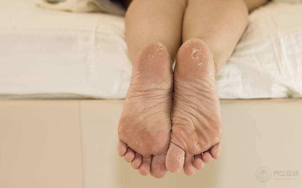 腳氣也是一種病，做到這一點能夠有效預防腳氣