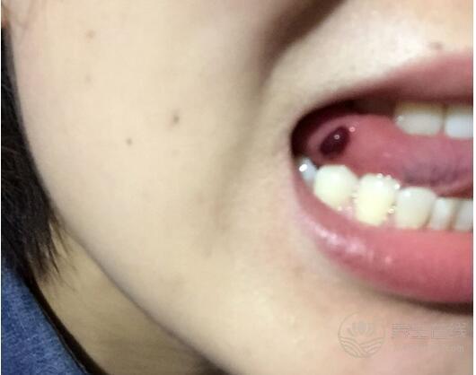 口腔上火以為不是什么大事，醫生檢查是早期舌癌！