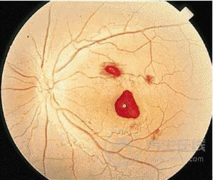 這兩類食物很毒，最容易導(dǎo)致肝癌，很多人還不注意