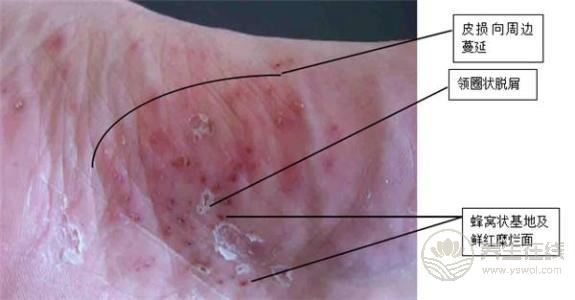 腳氣也是一種病，做到這一點能夠有效預防腳氣