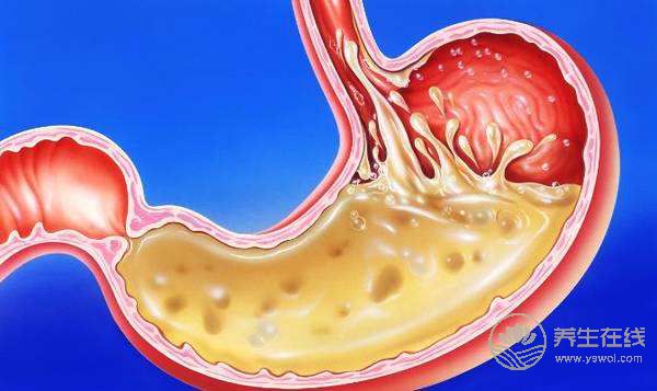 胃脹、胃酸、胃不舒服？簡單6招，還自己一個好胃