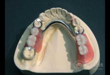 義齒有哪幾類，什么是義齒