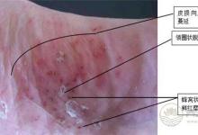 腳氣也是一種病，做到這一點(diǎn)能夠有效預(yù)防腳氣