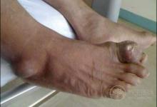 喝啤酒導致痛風嗎？喝酒為什么會痛風