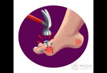 尿酸高的人注意，這3類食物碰多了，腎會“壞掉”！