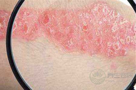 激素性皮炎不能吃什么?