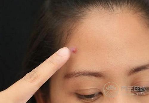 痘痘星人看過來，這3種食物咱別吃了，再好吃為了美也要忍