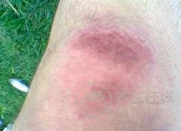 有哪些食物可以有助于消腫?