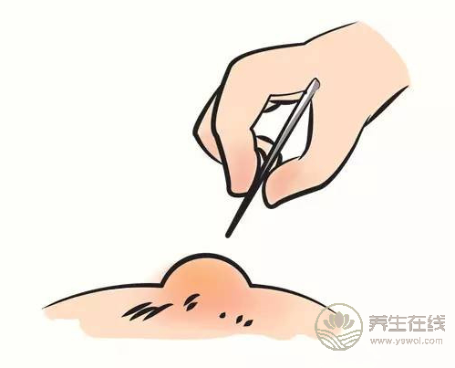 燙傷了怎么辦？6個處理誤區，還有很多人用