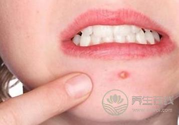 經(jīng)期狂長(zhǎng)痘痘怎么回事？排毒調(diào)理才是關(guān)鍵