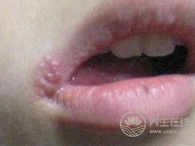 吃這些食物讓你嘴巴不上火起泡！