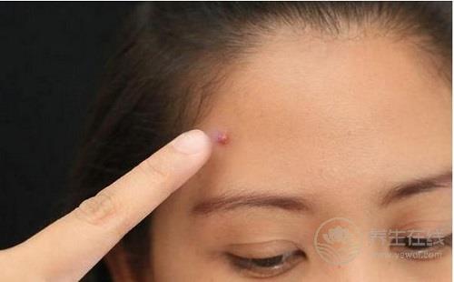 吃辣長痘痘原來是這原因,2招教你搞定 吃辣長痘痘原來是這原因,2招教你搞定