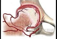 股骨頭壞死吃什么保養(yǎng)呢