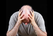 注意！這些因素都是導(dǎo)致禿頂?shù)摹皩?dǎo)火線”