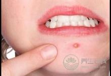 經期狂長痘痘怎么回事？排毒調理才是關鍵