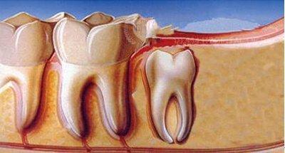 拔了盡頭牙也就是智齒要注意什么