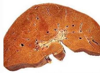 脂肪肝的檢查方法以及醫學檢查手段