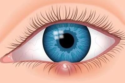 早期的麥粒腫應(yīng)該采取哪些手段消除 早期的麥粒腫應(yīng)該采取哪些手段消除