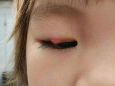 長針眼的處理方法和針眼的治療方法