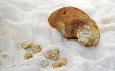 體內有結石的患者吃什么菜對身體最好