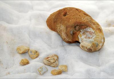 體內有結石的患者吃什么菜對身體最好