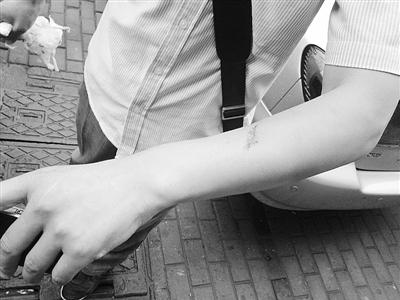 手臂出現肌肉拉傷情況需要如何處理