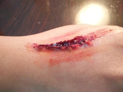 身體受傷用什么消炎對傷口效果最好