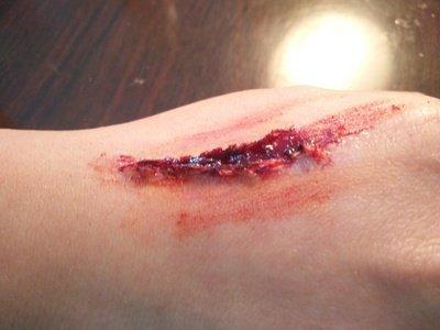 身體受傷用什么消炎對傷口效果最好