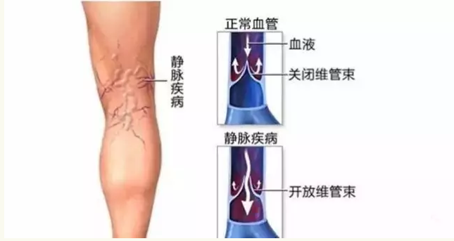 喝酒是否會影響到靜脈曲張患者的健康