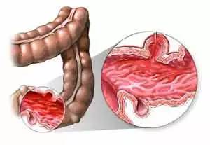 在懷孕期間出現腸胃炎要如何治療