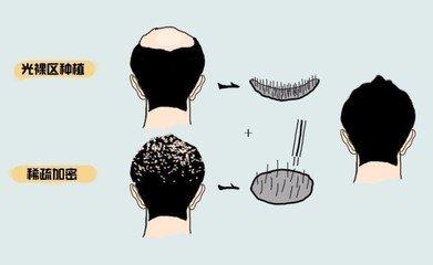 植發對于身體存在著哪些方面的危害
