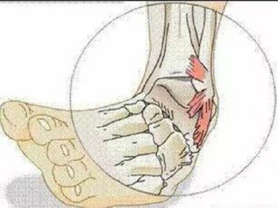 崴腳之后需要冷敷多長時間進行緩解