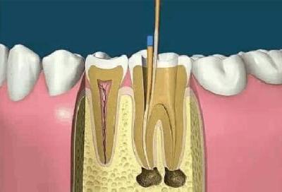 殺牙神經(jīng)對于身體的好處與壞處有哪些