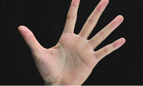 導(dǎo)致手心容易潮濕經(jīng)常出汗的原因